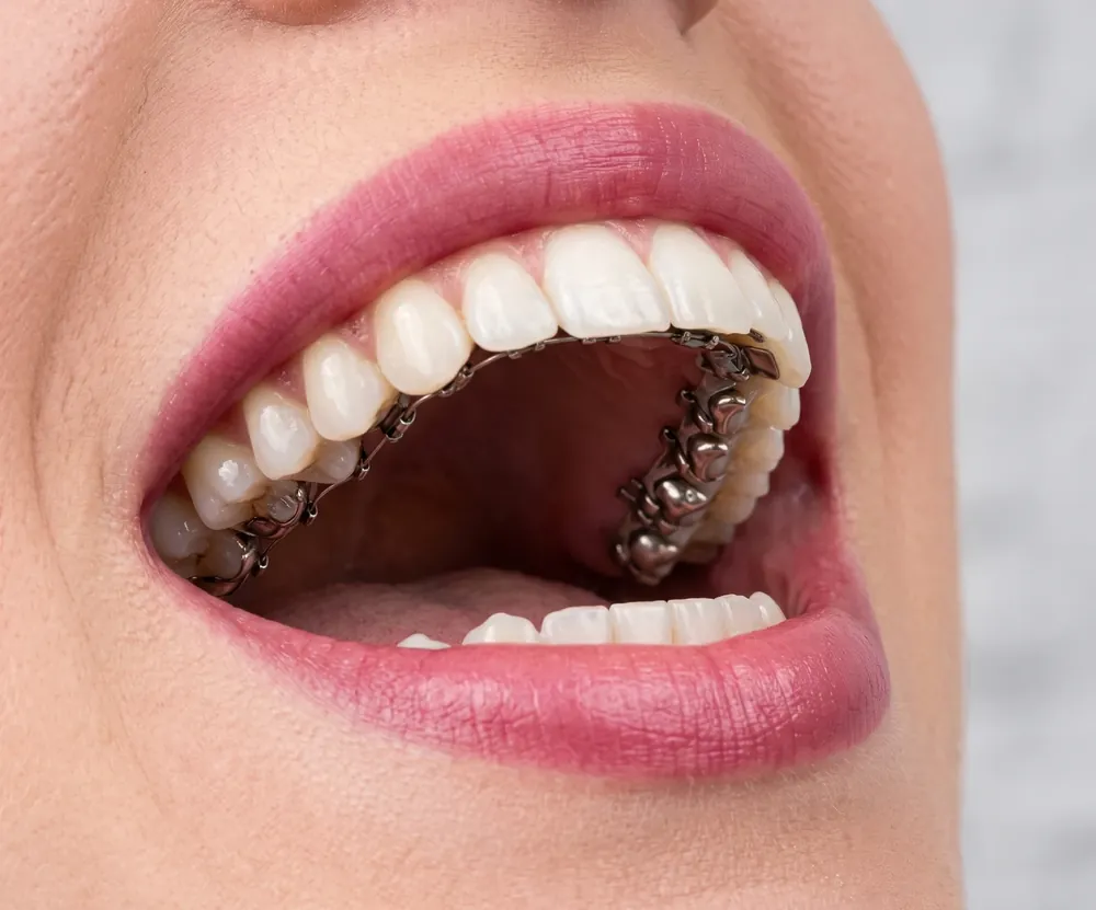 Brackets linguales colocados en la cara interna de los dientes