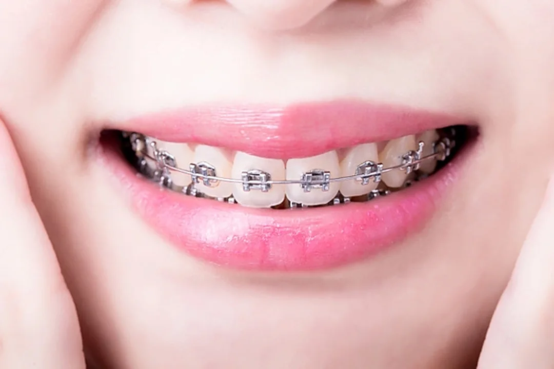 Sonrisa con brackets metálicos de acero