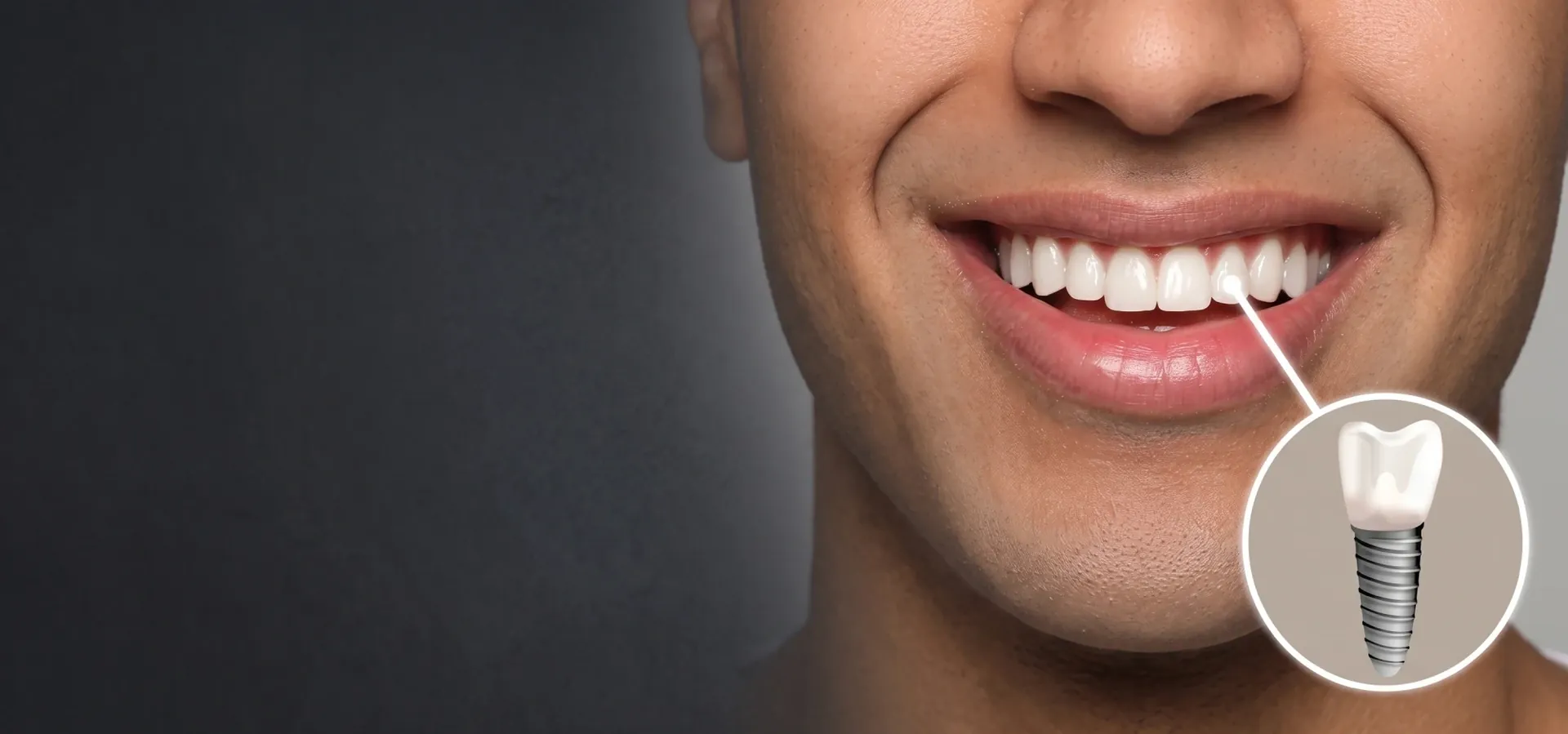 Sonrisa con ilustración de un implante dental de titanio con su corona